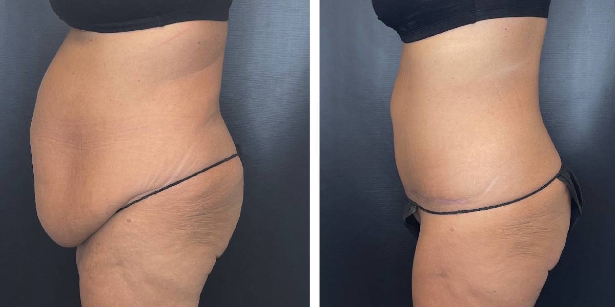 before and after tummy tuck female patient left side view case 1794