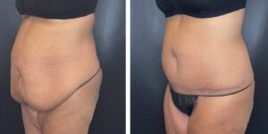 before and after tummy tuck female patient left angled view case 1794