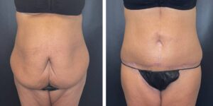 before and after tummy tuck female patient front view case 1794