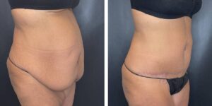 before and after tummy tuck female patient right angled view case 1794