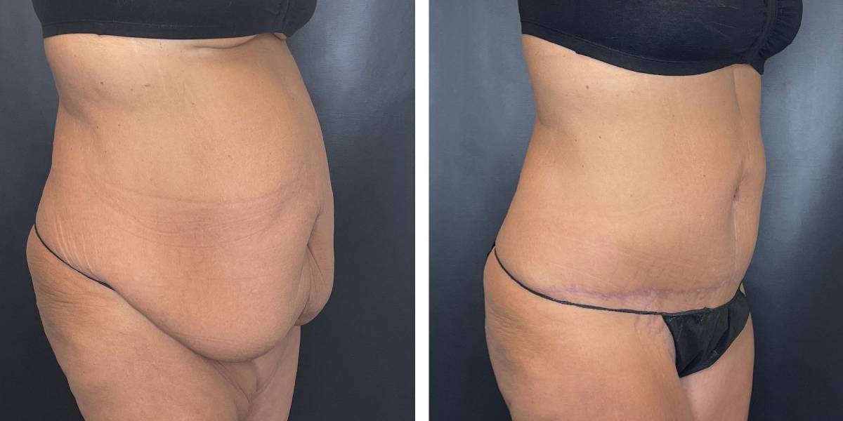 before and after tummy tuck female patient right angled view case 1794