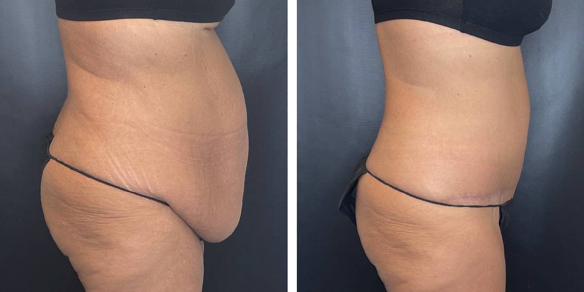 before and after tummy tuck female patient right side view case 1794
