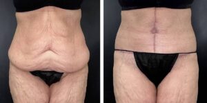before and after tummy tuck female patient front view case 1800