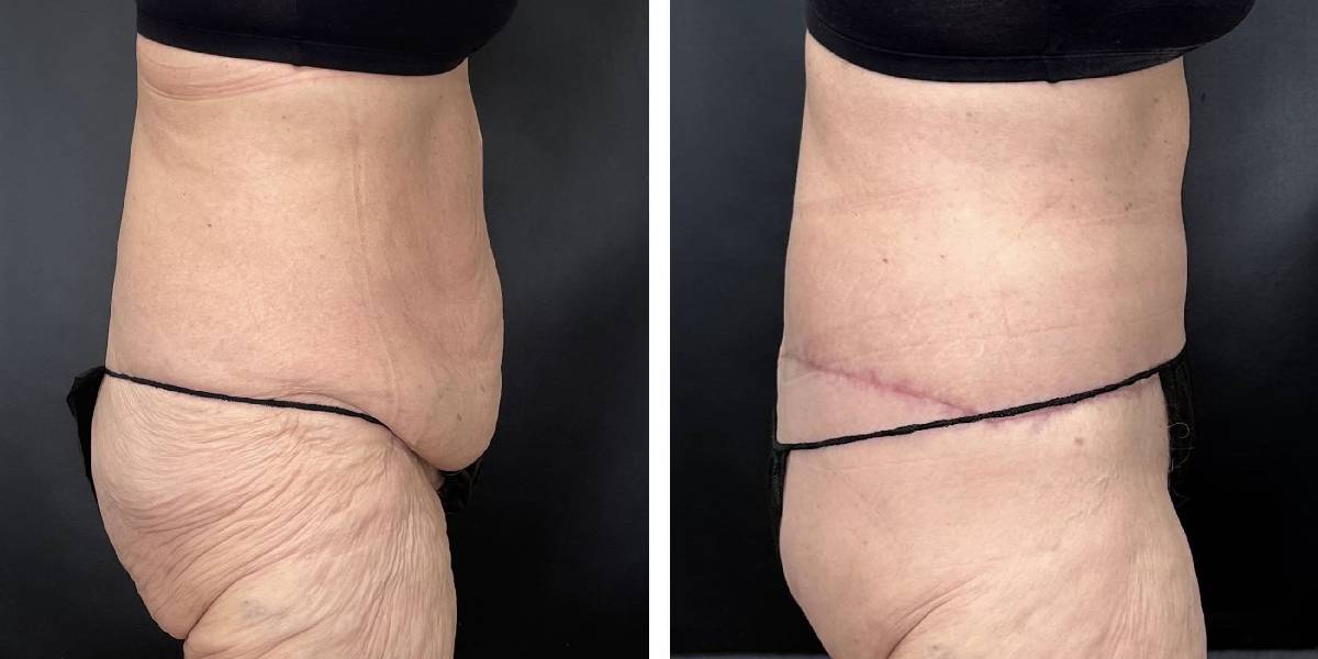 before and after tummy tuck female patient right side view case 1800