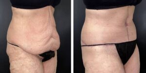 before and after tummy tuck female patient right angled view case 1800