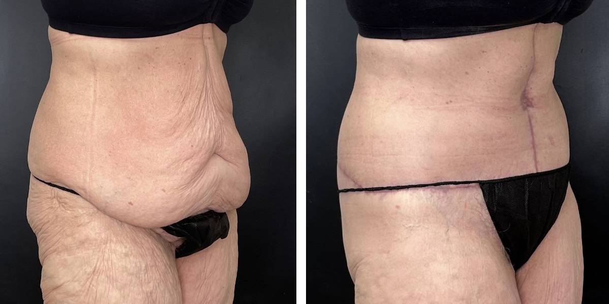 before and after tummy tuck female patient right angled view case 1800