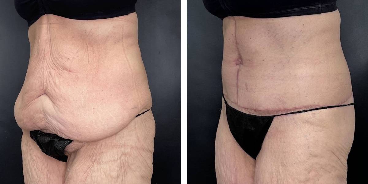 before and after tummy tuck female patient left angled view case 1800