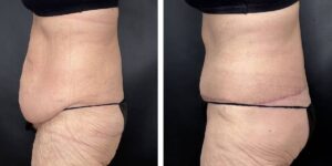 before and after tummy tuck female patient left side view case 1800
