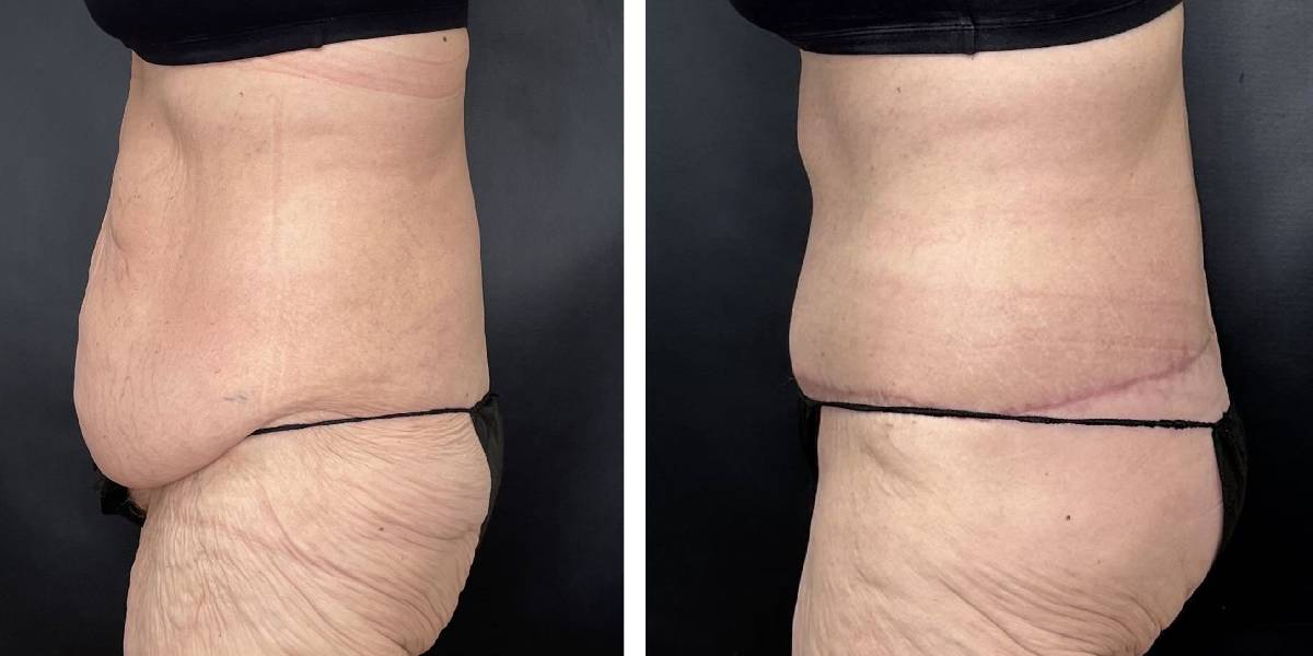 before and after tummy tuck female patient left side view case 1800