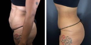 before and after tummy tuck female patient left side view case 1807