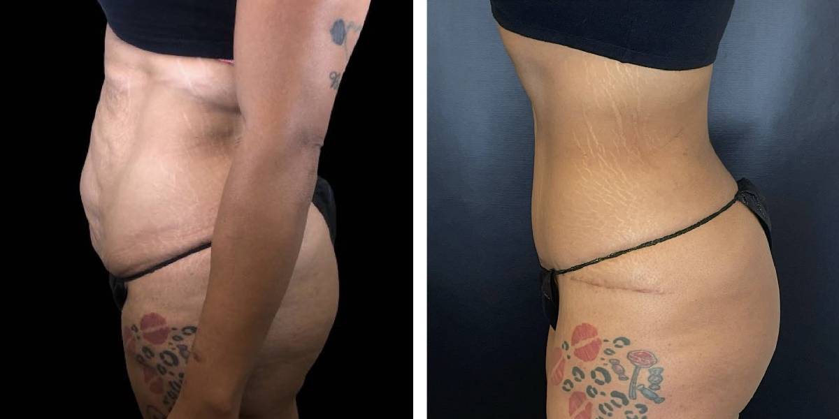 before and after tummy tuck female patient left side view case 1807