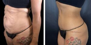 before and after tummy tuck female patient left angled view case 1807