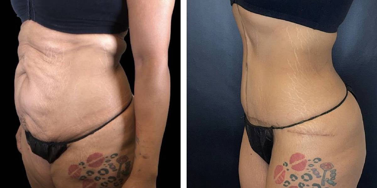 before and after tummy tuck female patient left angled view case 1807
