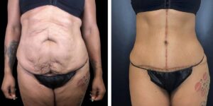 before and after tummy tuck female patient front view case 1807