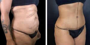 before and after tummy tuck female patient right angled view case 1807