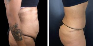 before and after tummy tuck female patient right side view case 1807