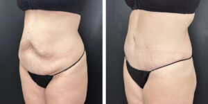 before and after tummy tuck left angle view female patient case 894