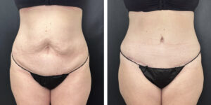 before and after tummy tuck front view female patient case 894