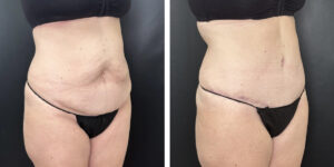before and after tummy tuck right angle view female patient case 894