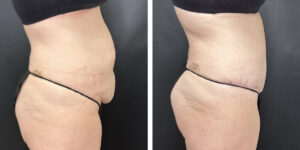 before and after tummy tuck right side view female patient case 894