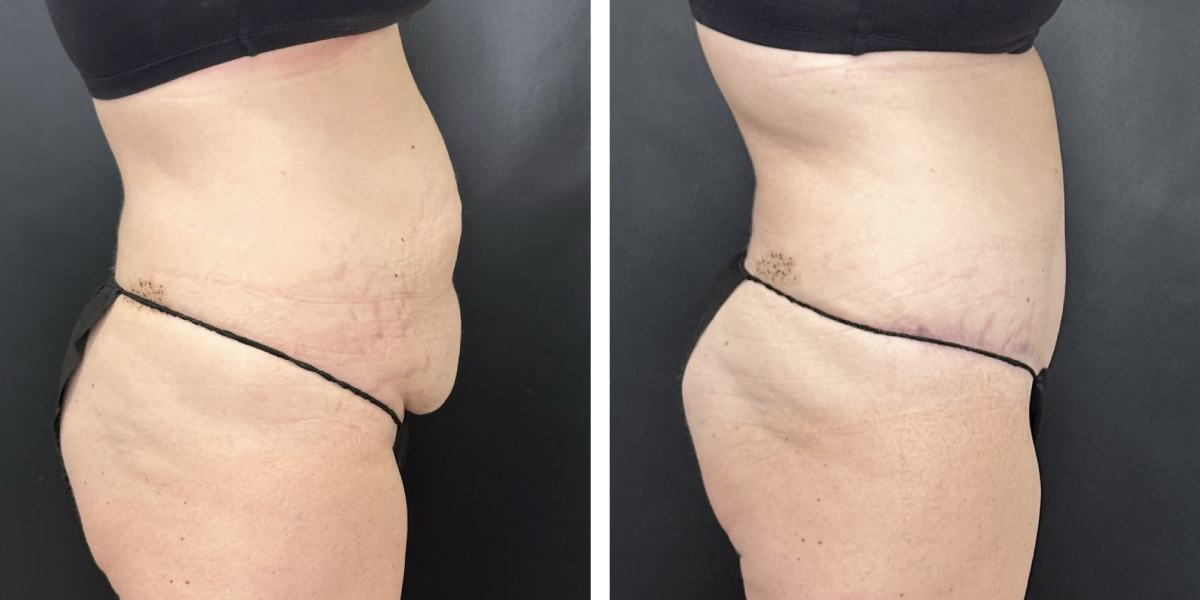 before and after tummy tuck right side view female patient case 894