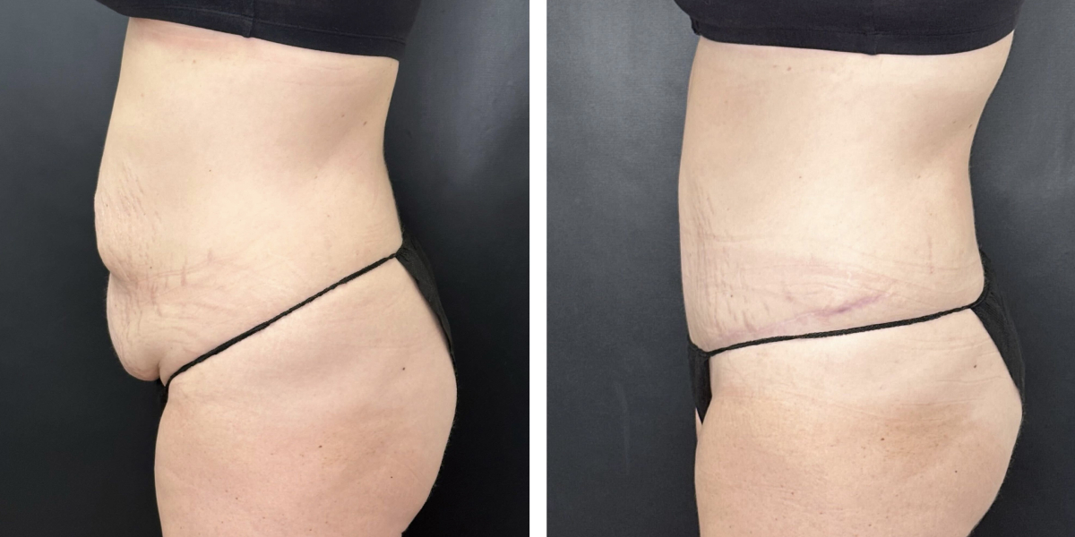 before and after tummy tuck left side view female patient case 894