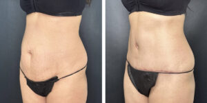 before and after tummy tuck left angle view female patient case 900