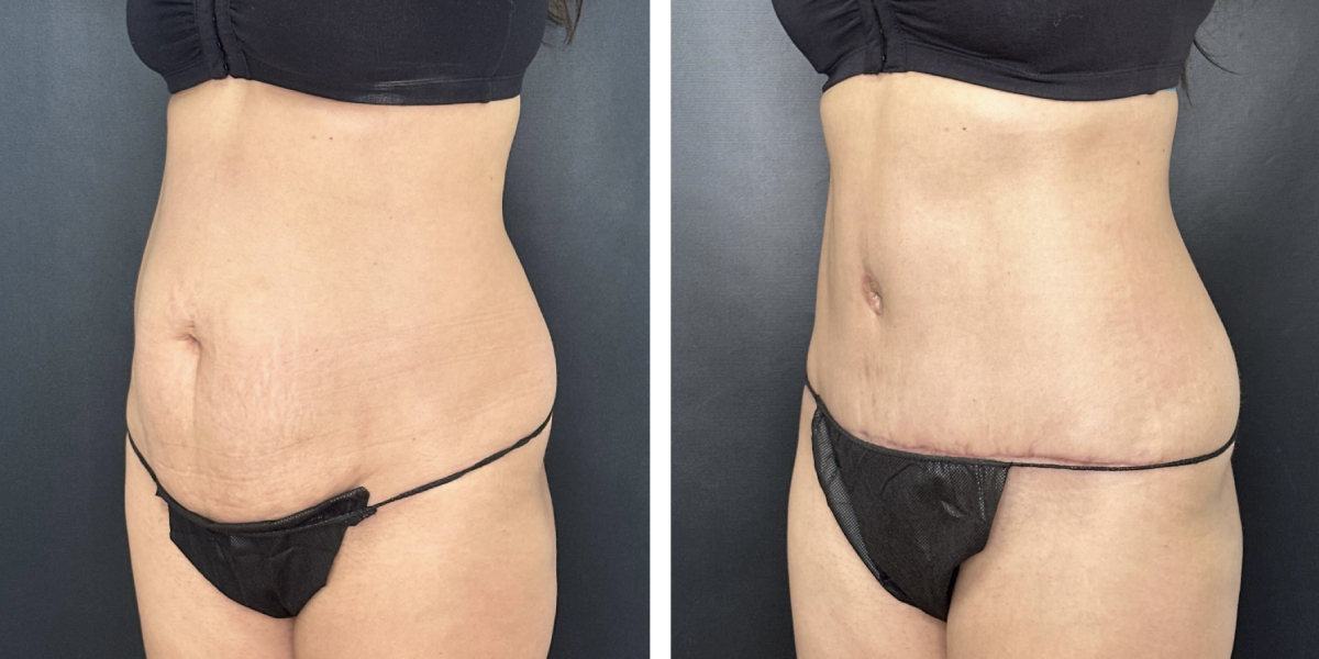 before and after tummy tuck left angle view female patient case 900