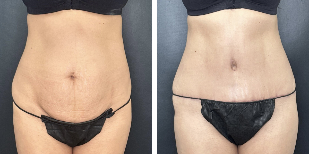 before and after tummy tuck front view female patient case 900