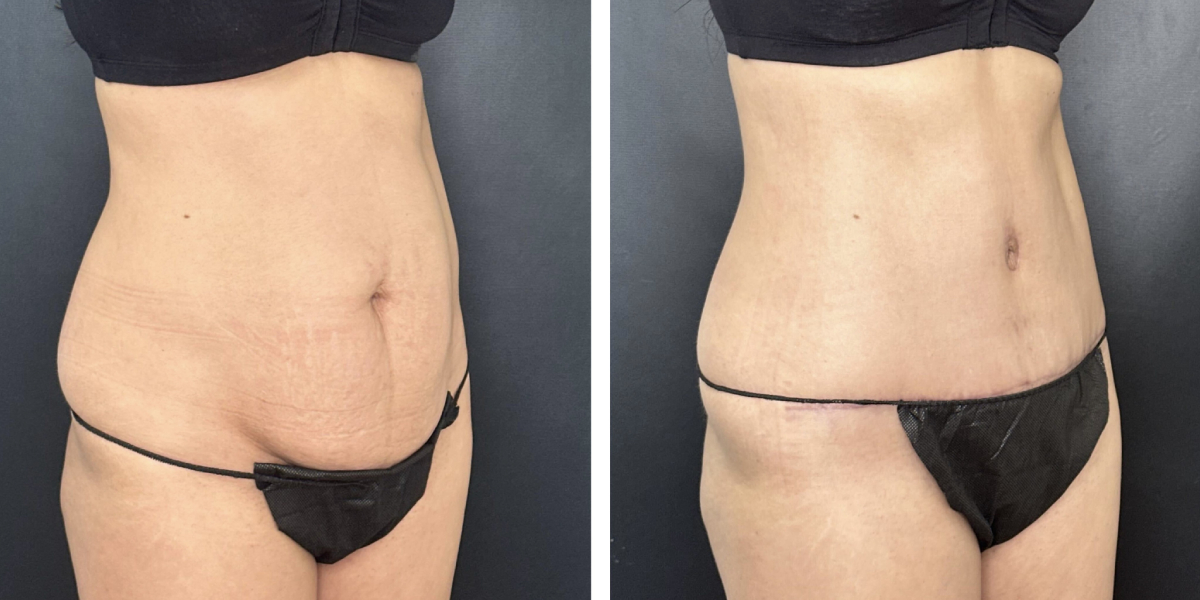 before and after tummy tuck right angle view female patient case 900