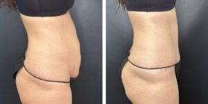 before and after tummy tuck right side view female patient case 900