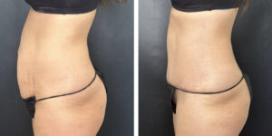 before and after tummy tuck left side view female patient case 900