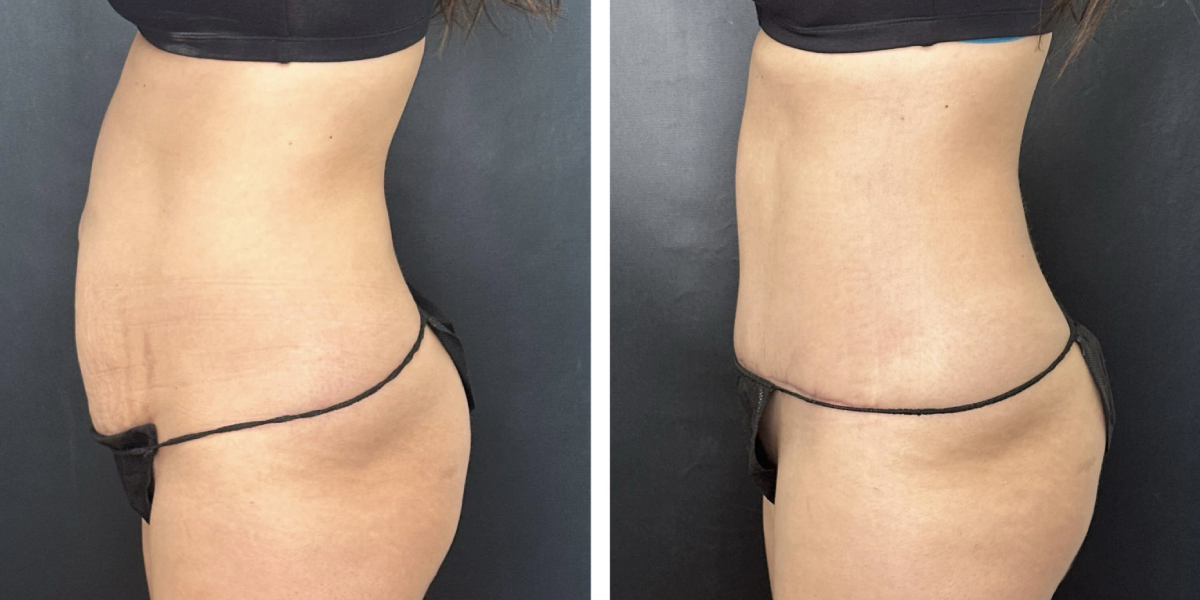 before and after tummy tuck left side view female patient case 900
