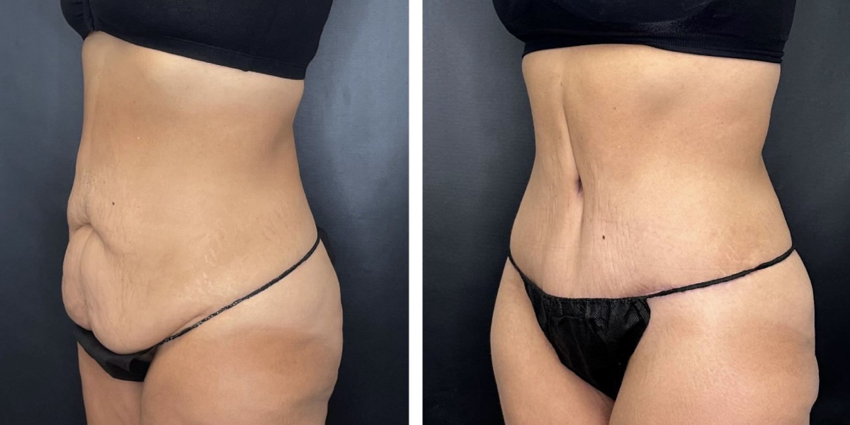 before and after tummy tuck left angle view female patient case 906