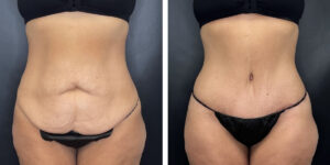 before and after tummy tuck front view female patient case 906