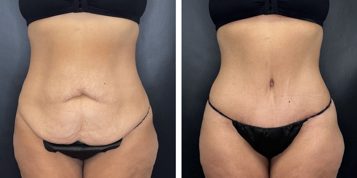 before and after tummy tuck front view female patient case 906