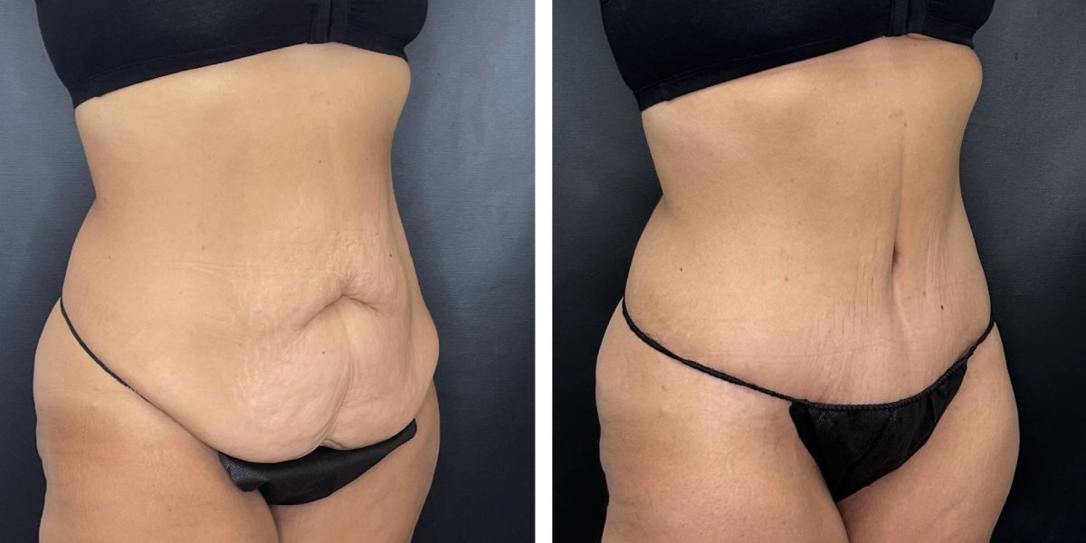 before and after tummy right angle side view female patient case 906