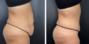 before and after tummy tuck right side view female patient case 906