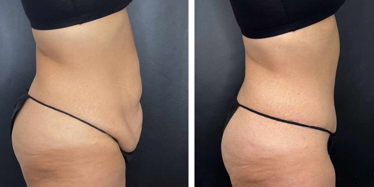 before and after tummy tuck right side view female patient case 906