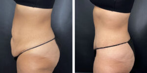 before and after tummy tuck left side view female patient case 906