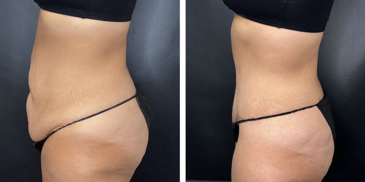 before and after tummy tuck left side view female patient case 906