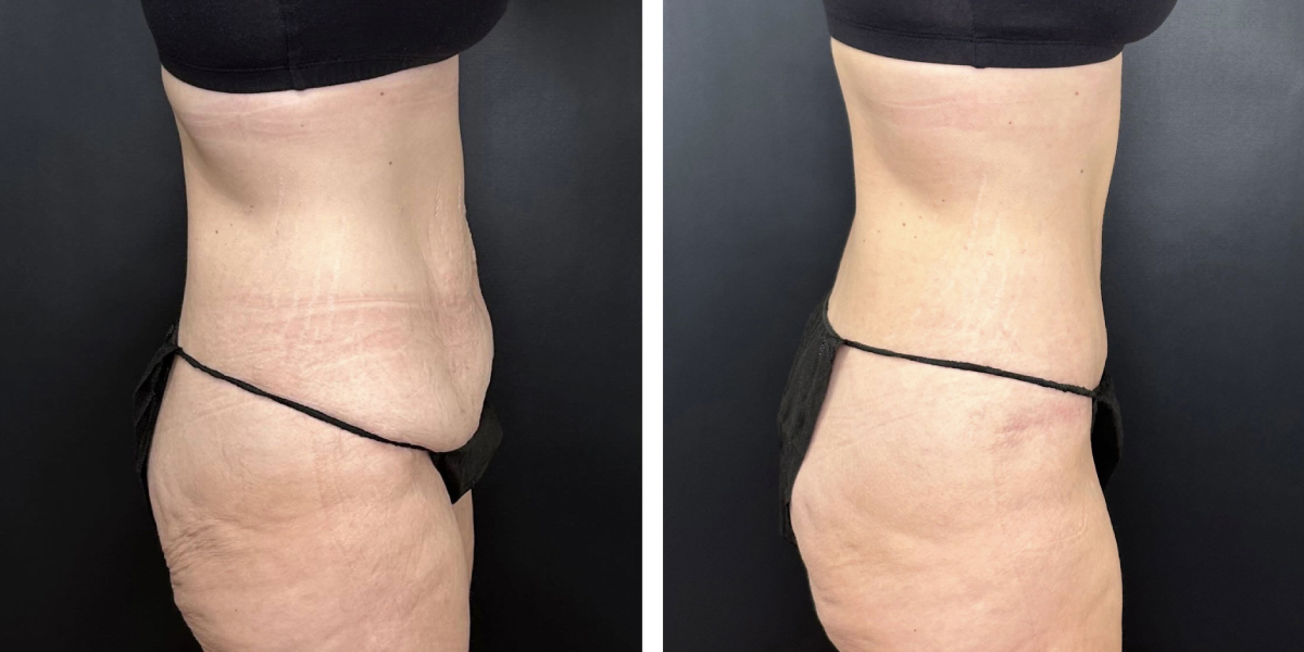 before and after tummy tuck right side view female patient case 912