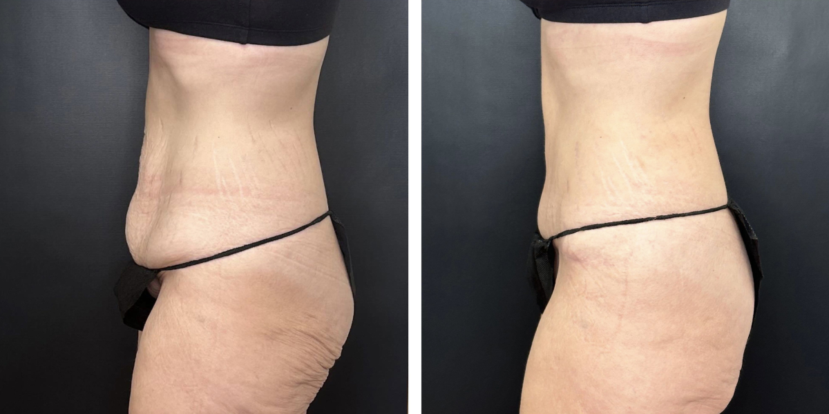 before and after tummy tuck left side view female patient case 912
