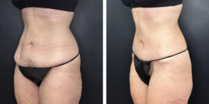 before and after tummy tuck left angle view female patient case 912