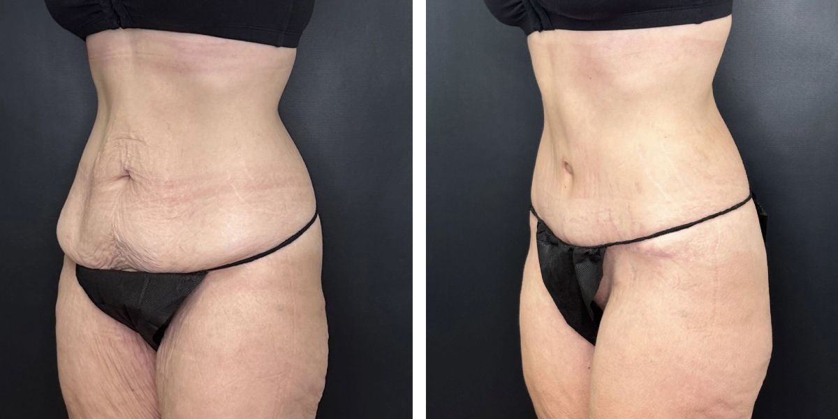 before and after tummy tuck left angle view female patient case 912