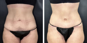 before and after tummy tuck front view female patient case 912