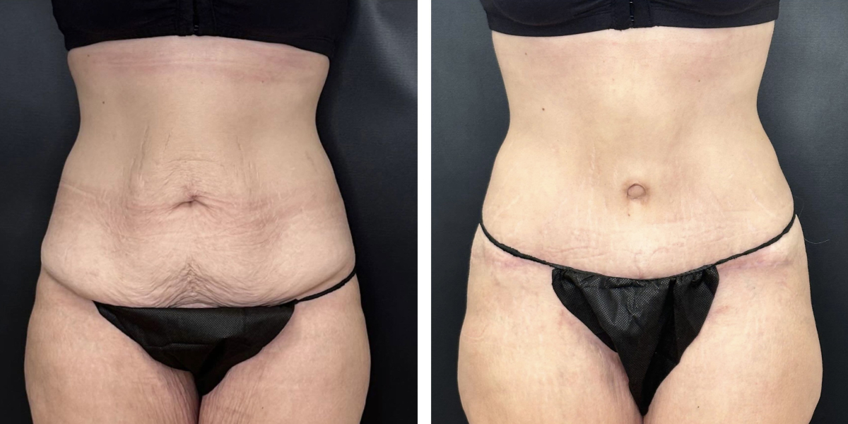 before and after tummy tuck front view female patient case 912