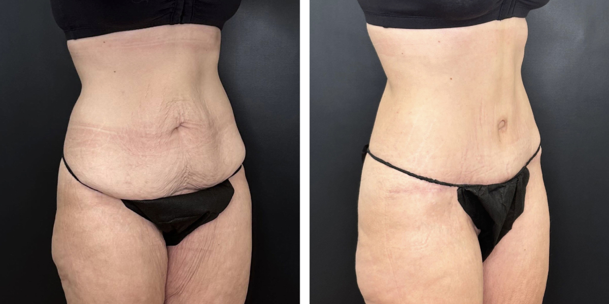before and after tummy tuck right angle view female patient case 912