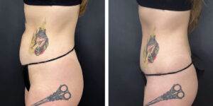 before and after tummy tuck left side view female patient case 918