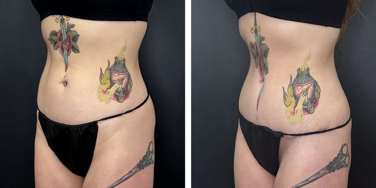 before and after tummy tuck left angle view female patient case 918